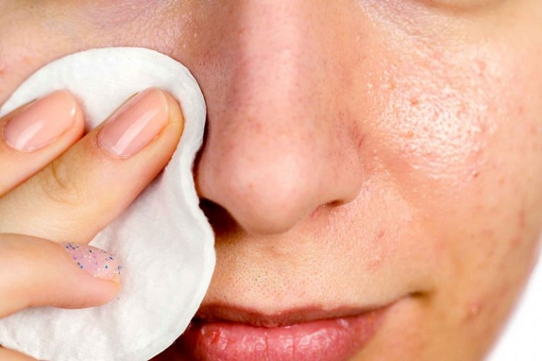 6 home remedies to remove skin blemishes