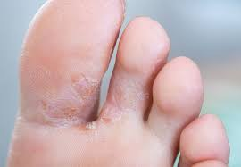 How to Prevent Athlete’s Foot